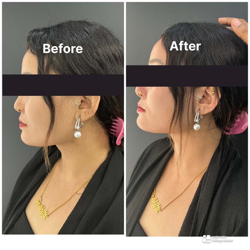 Fillers result KOQ10